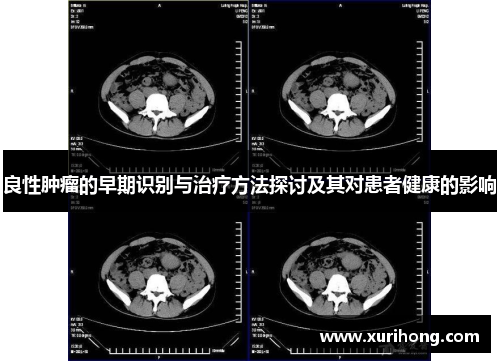 良性肿瘤的早期识别与治疗方法探讨及其对患者健康的影响