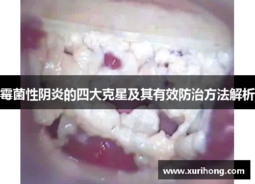 霉菌性阴炎的四大克星及其有效防治方法解析